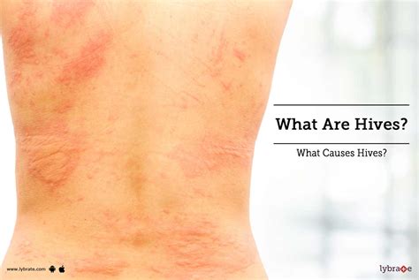 Urticaria Hives Causes Symptoms And Treatments