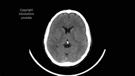 Ct Scan Brain Head Without Inject Oral Contrast Philips Brilliance 64