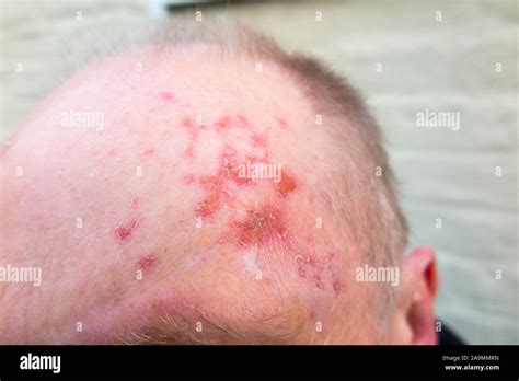 Precancerous Lesion Hi Res Stock Photography And Images Alamy