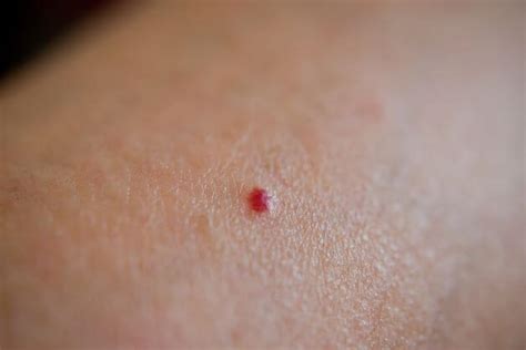 Cherry Angioma Removal Causes Treatment And Pictures