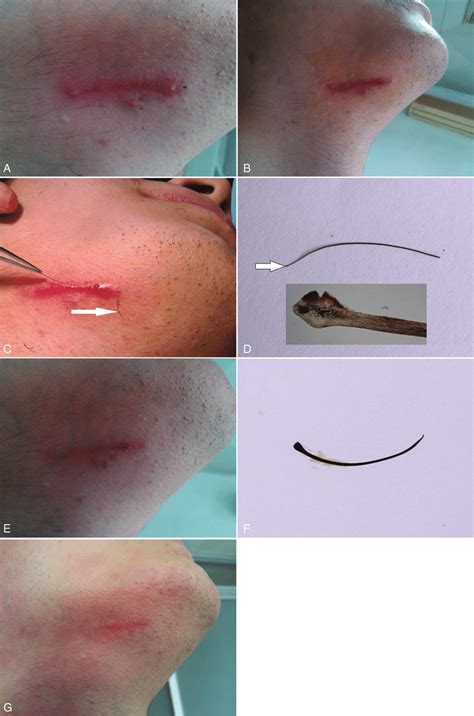 The Presentations Of Ingrowing Hair A 43 Cm Long Black Linear Lesion
