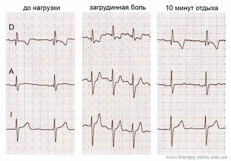 Экг при ишемической болезни сердца: признаки, диагностика, изменения Картинка - Экг при ишемической болезни сердца: признаки, диагностика, изменения