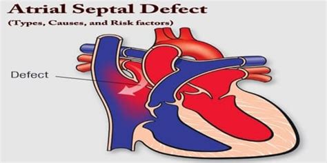 Atrial Septal Defect Types Causes And Risk Factors Assignment Point