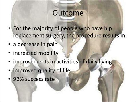 Ppt Hip Arthroplasty Powerpoint Presentation Free Download Id1209827