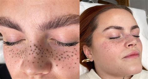 Womans Freckle Tattoo On Face Goes Badly Wrong