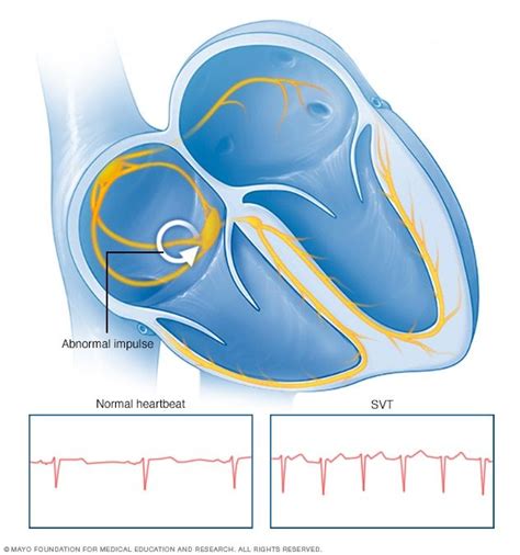Taquicardia Supraventricular Síntomas Y Causas Mayo Clinic Cardiac