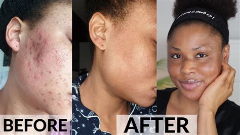 How I Cleared My Acne Oily Skin Dark Spots And Hyperpigmentation