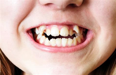 The Danger Behind Crooked Teeth
