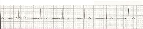 EKG Rhythm Strips 15 Sinus Rhythms
