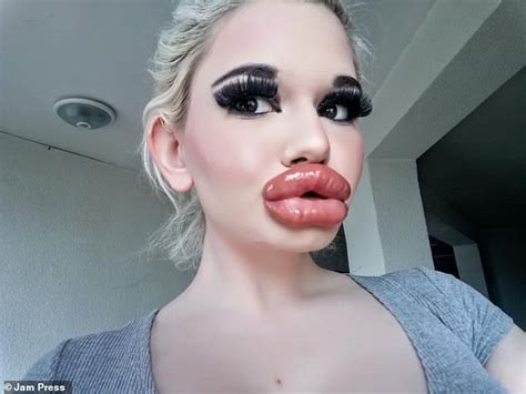 Woman 22 Who Has Spent Thousands Quadrupling The Size Of Her Lips