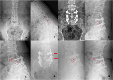 Ab A 74 Year Old Male Diagnosed As Spondylolysis At The L4 Vertebral