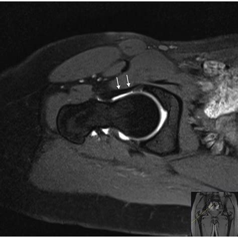 Mri Arthrography Oblique Axial T1 Weighted Fatsuppressed Image Showing