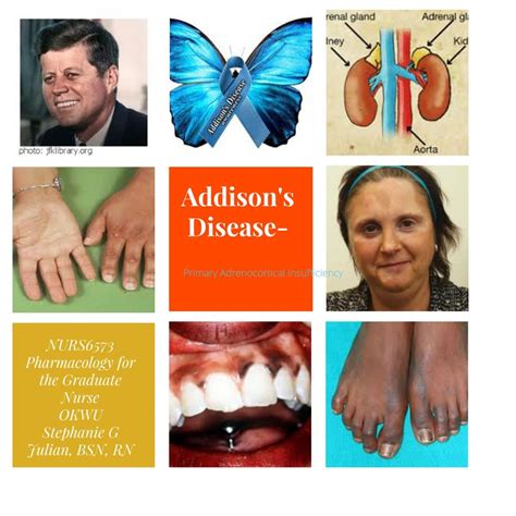 Addison S Disease By Stephanie G Julian Bsn Rn For Okwu Ed By Stephanie Julian Flipsnack