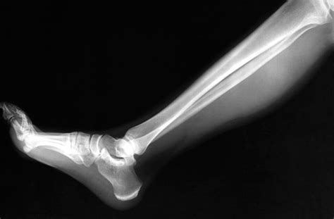 5 Most Commonly Broken Bones Howstuffworks