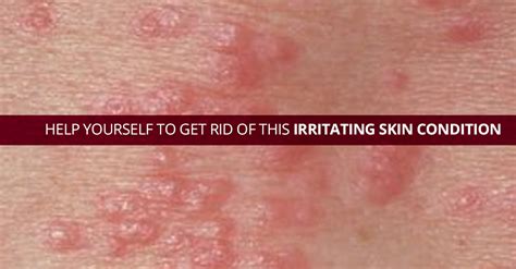 What Is The Best Way To Treat Scabies At Home Marham