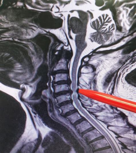 Posterior Cervical Laminectomy And Fusion Neurosurgery Of St Louis