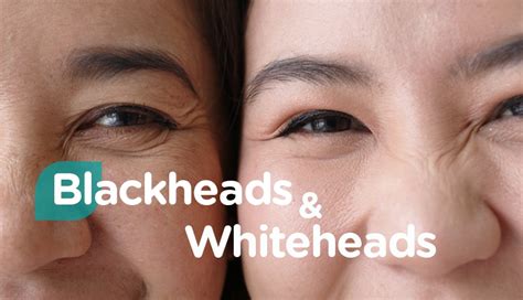 How To Get Rid Of Blackheads And Whiteheads Watsons Malaysia