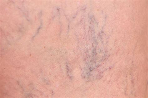 Varicose Veins On Female Legs In The Hips Sipder Veins Thigh Close Up