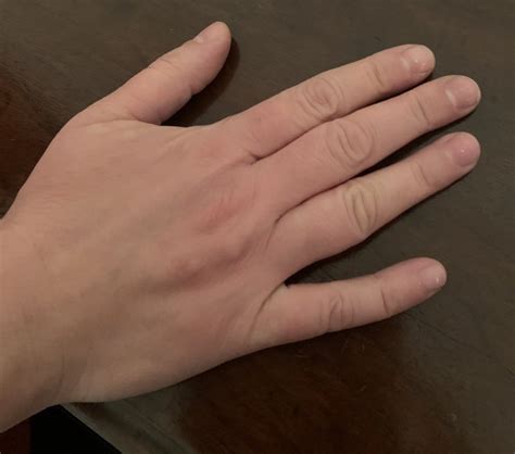 Dermatite da contatto? - Orticaria / dermografismo ...
