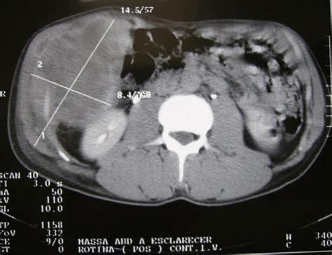 Abdominal Wall Sarcoma A Rare Tumor And Surgical Treatment Proposed