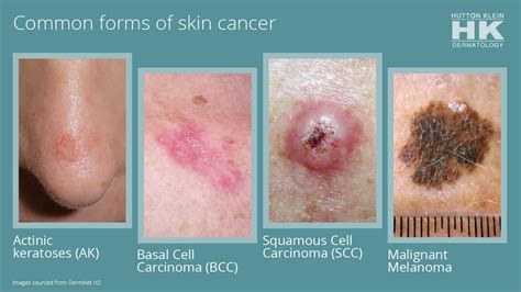What Does Skin Cancer Look Like Images What Does Skin Cancer Look