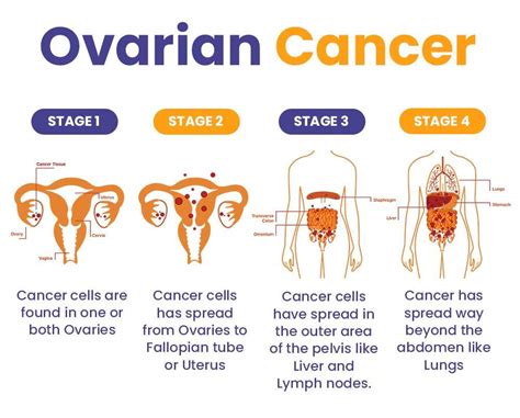 Affordable Cost Ovarian Cancer Treatment In Ludhiana Punjab