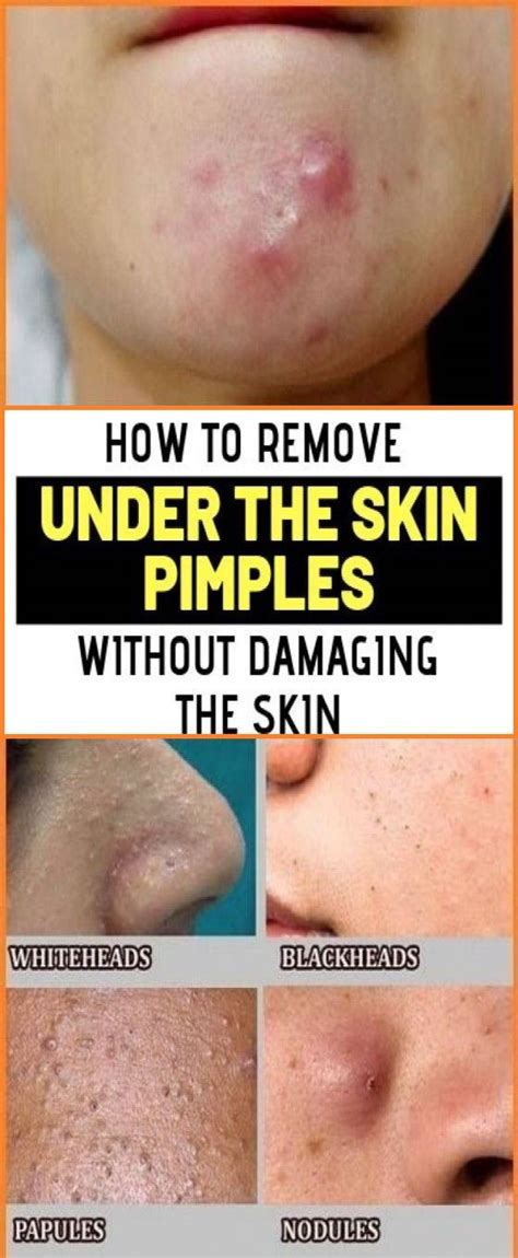 Pin By Atlanta Yiannakis On Personal Training Pimples Under The Skin