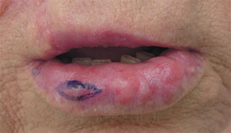 Nontender Nodules On The Lower Lip Mdedge Dermatology