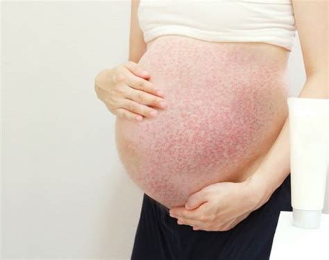 Polymorphic Eruption Of Pregnancy Causes Symptoms And