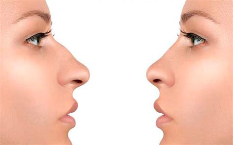 Existe el prototipo de nariz perfecta Cirugía Plástica En Mérida Yucatán