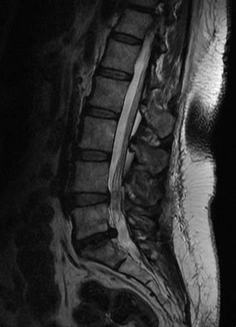 Intraspinal Synovial Cyst Wikidoc