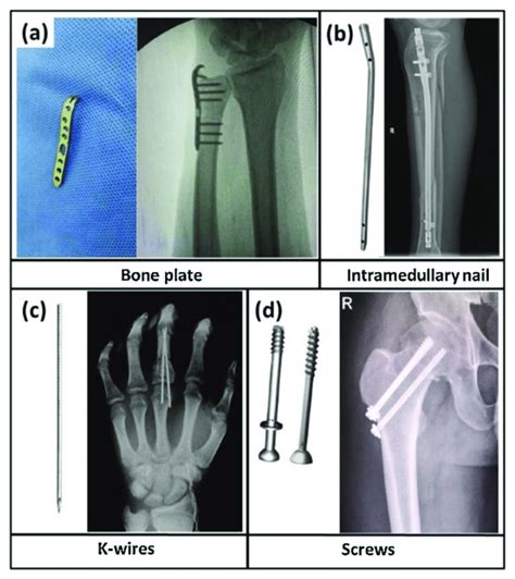 Examples Of Bone Fixation Devices A A Bone Plate B An