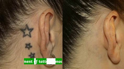 After rubbing the melon juice, wait until it dries up and your skin becomes hard. Permanent Tattoo Removal Treatment - YouTube