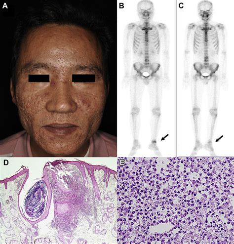 A Chronic Severe Nodulocystic Acne On Face With Severe Sinus Tracts