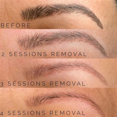 Saline Removal Course Esthetic World Beauty Microblading