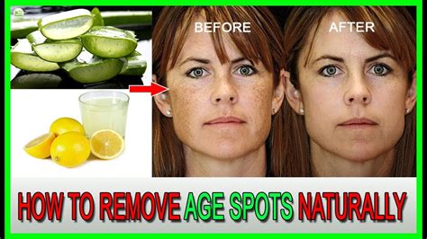 How to get clear skin, remove acne, and dark circles. Skin Care - How To Remove Age Spots Naturally - Dark Spots ...