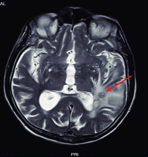 Magnetic Resonance Imaging Mri Of Brain T2 Sequence Showing Cerebral