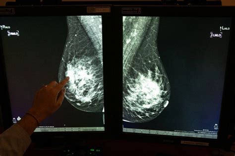 Breast Cancer Faq 8 Things You Should Know About Getting Your First