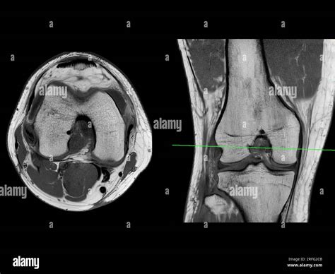 Magnetic Resonance Imaging Or Mri Of Knee Joint Axial T2 And Coronal