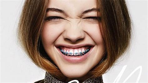 Are Braces Really A New Fashion Trend Metro Us