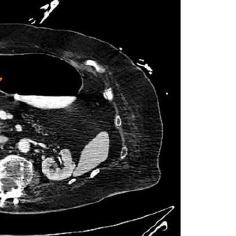 Contrast Enhanced Ct Scan Presents Gallbladder Penetration In The