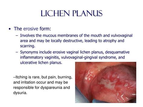 Benign Disorders Of The Vulva Pruritus Itchy Vulva Vulval Skin And Images And Photos Finder