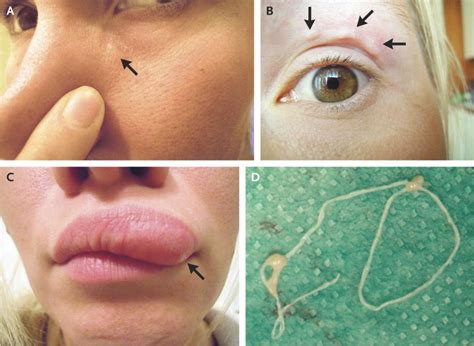 Moving Lump On Womans Face Turns Out To Be A Worm Newshub