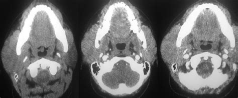 Computerized Tomography Scan Of Parotid Region Showing Diffusely