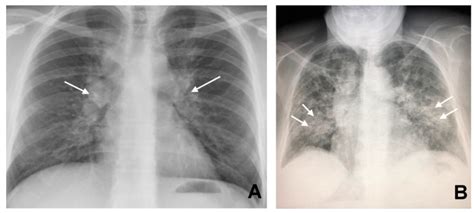 Bilateral Hilar Lymphadenopathy A Arrows And Bilateral Parenchymal