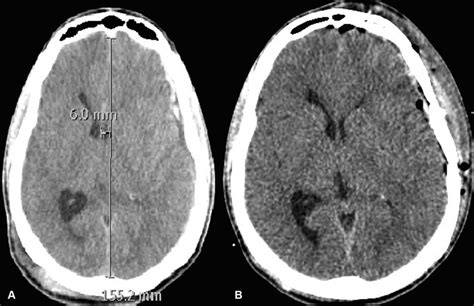 A Admission Axial Brain Computed Tomography Revealing A Left Subdural