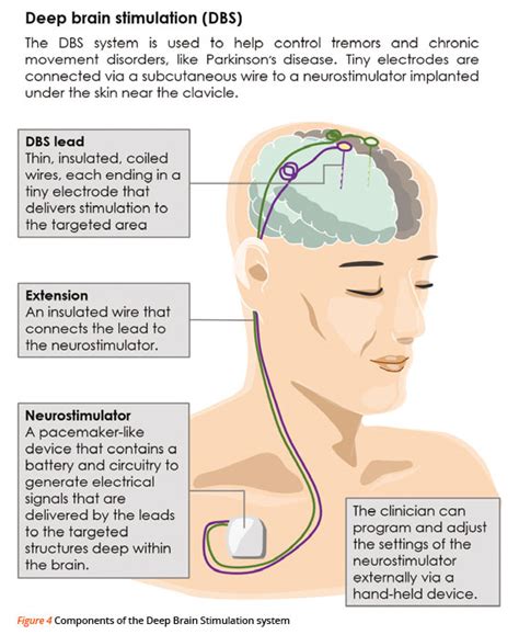 Deep Brain Stimulation For Parkinsons Disease Singhealth