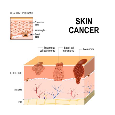 Skin Cancer Treatment In Toms River Nj Skin Cancer Causes Free Download Nude Photo Gallery