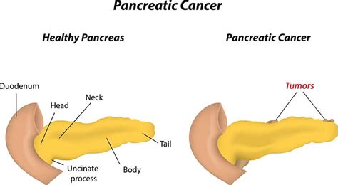 Pancreatic Cancer Symptoms 12 Warning Signs Of Pancreatic Cancer