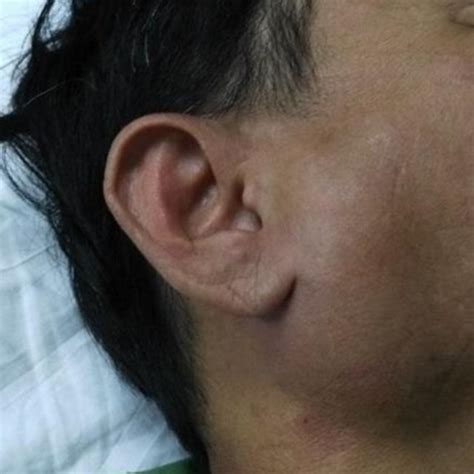 Swelling Of Right Parotid Gland A Firm Mass Of 4 Cm In Size Globular